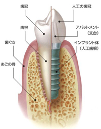 インプラント