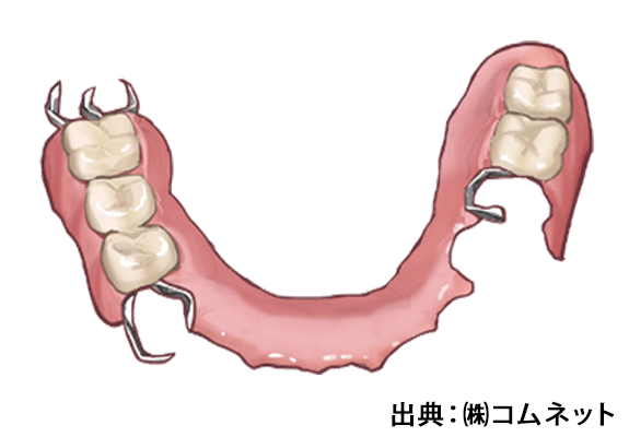 部分入れ歯にしたけれど