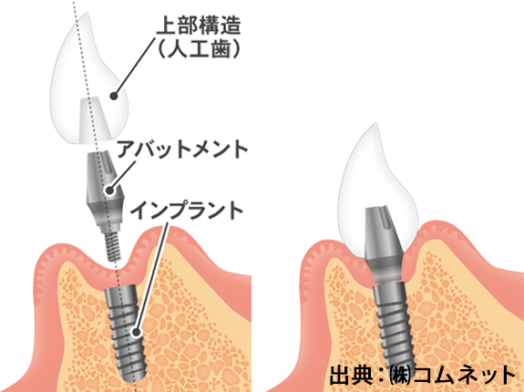 インプラント治療のメリット