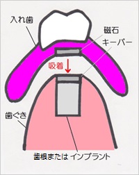 磁石式入れ歯